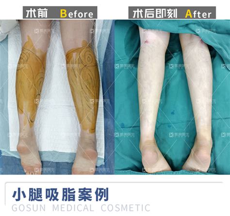 全身吸脂塑形的方法?
