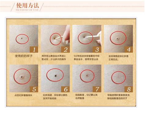 激光点痦子 去痦子什么方法好