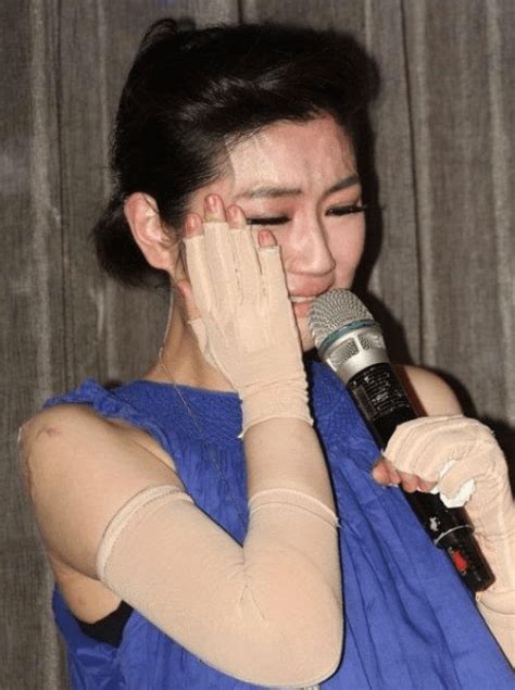 任家萱被烧伤的图片 她被烧伤哪里