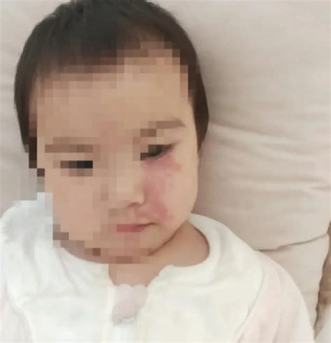 小柳千春出生带有红胎记怎么去掉好