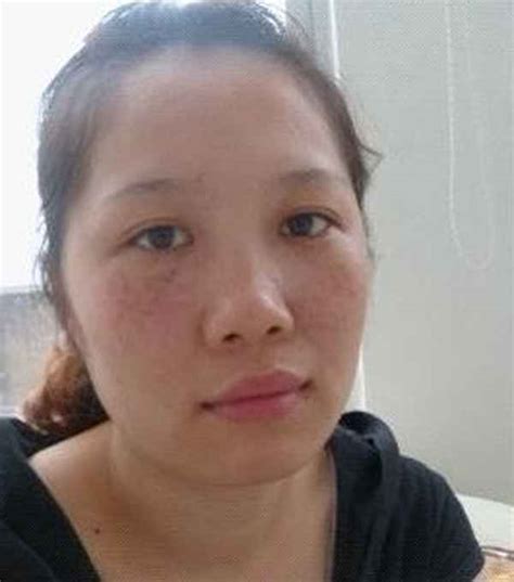 美容整形一般要多少钱
